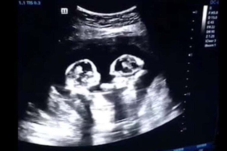 متى يظهر التوأم في كيس واحد داخل الرحم ؟ 2022 10 متى يظهر التوأم في كيس واحد داخل الرحم
