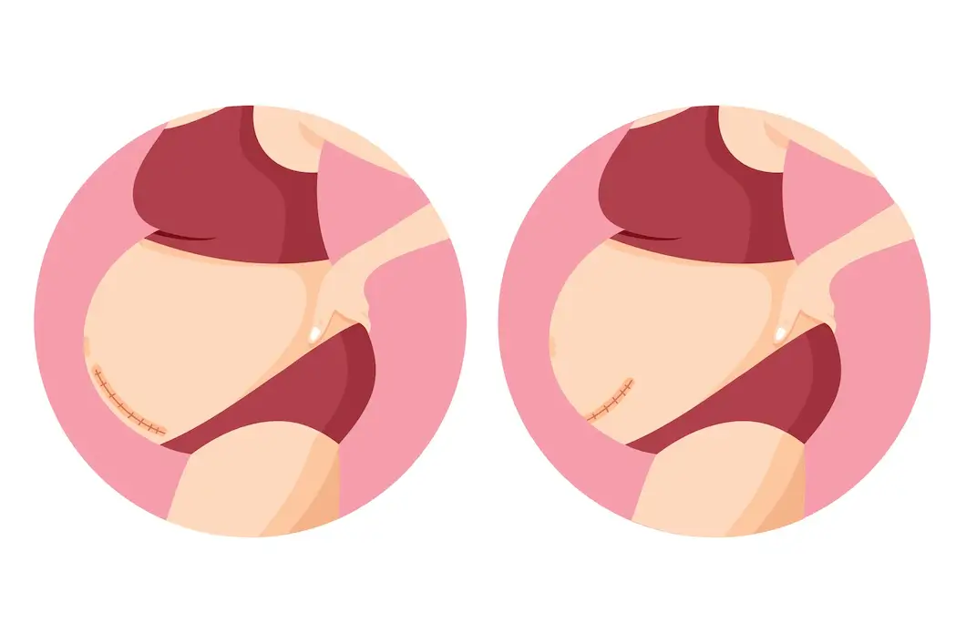 تعرف على الولادة القيصرية وأنواعها 3 الولادة القيصرية