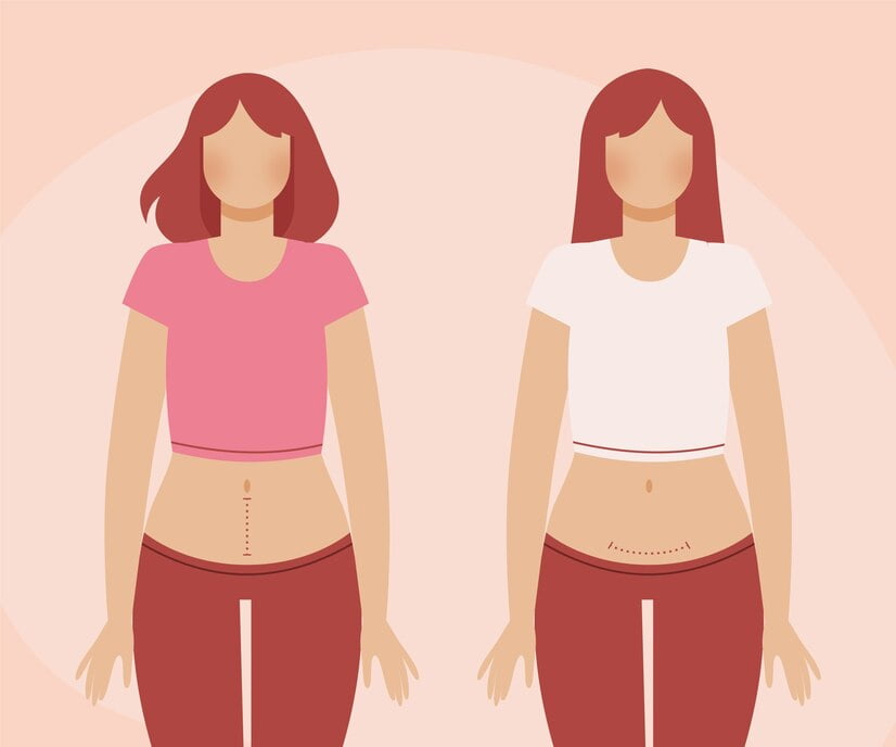 اعراض ما بعد الولادة القيصرية