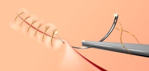 أعراض التهاب الخياطة بعد الولادة الطبيعية 1 أعراض التهاب الخياطة بعد الولادة الطبيعية