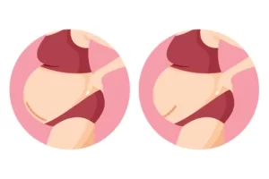 الولادة القيصرية