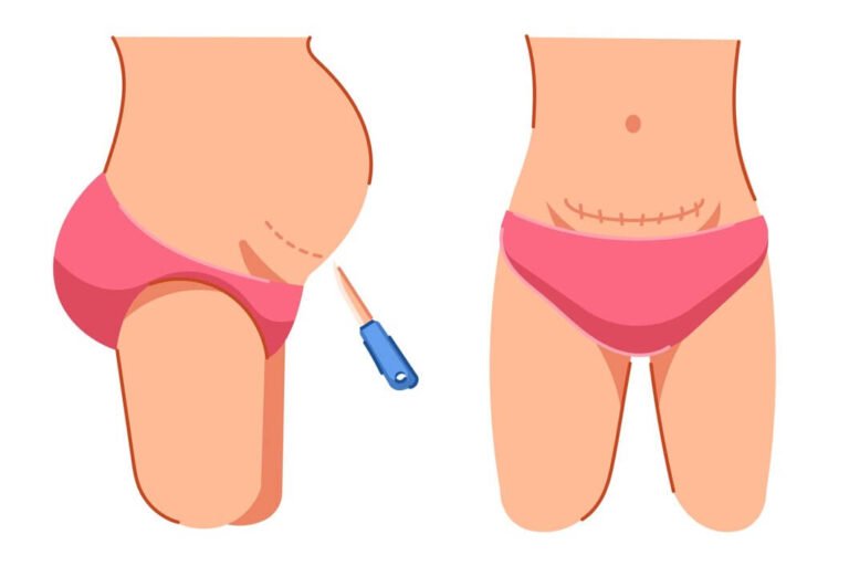 شكل البطن بعد الولادة القيصرية 4 البطن بعد الولادة القيصرية