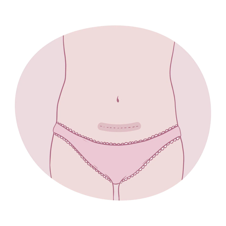 البطن بعد الولادة القيصرية