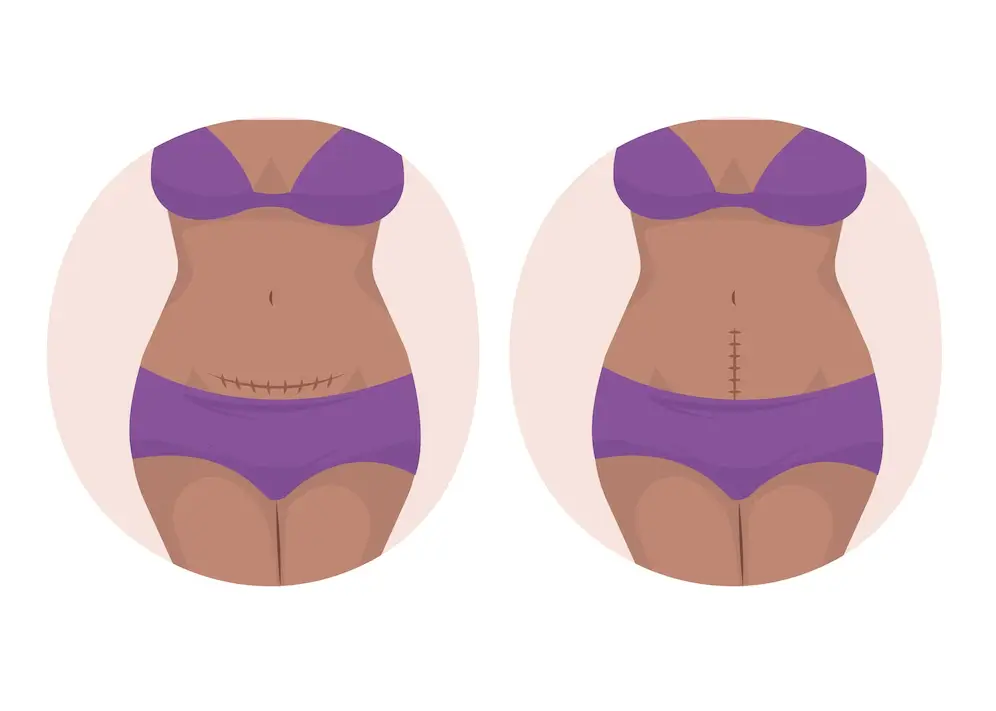 تعرف على الولادة القيصرية وأنواعها 1 الولادة القيصرية