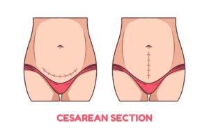 عيوب الولادة القيصرية