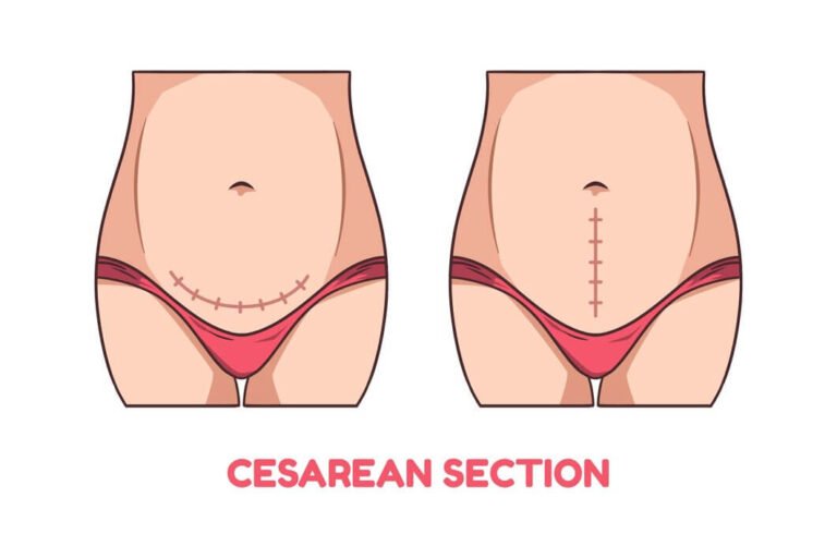 عيوب الولادة القيصرية في 7 نقاط 1 عيوب الولادة القيصرية