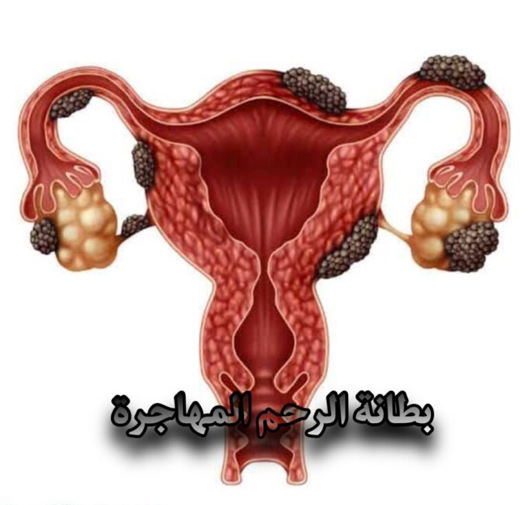 هل بطانة الرحم المهاجرة يتم اكتشافها بالسونار المهبلي 9 هل بطانة الرحم المهاجرة يتم اكتشافها بالسونار المهبلي