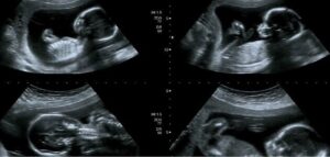 متى يظهر نوع الجنين وطرق الكشف الأبرز لعام 2022